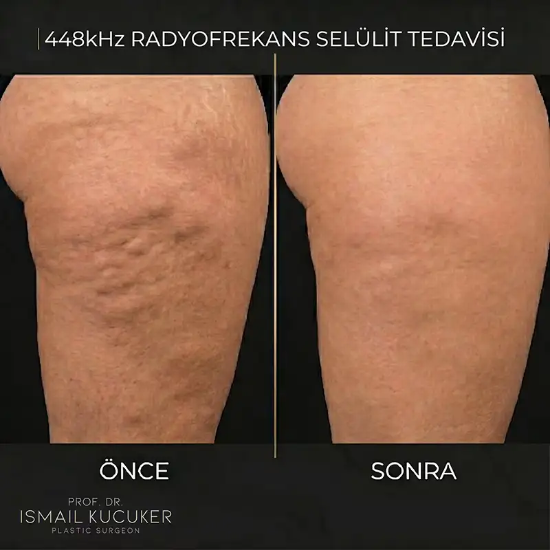 Hera 448 kHz Radyofrekans Selülit ve Bölgesel Sıkılaşma Sonuçları
