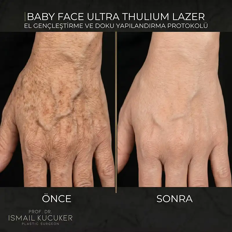 Baby Face Ultra Thulium Lazer El Gençleştirme ve Doku Yapılandırma Protokolü Öncesi Sonrası Değişimi