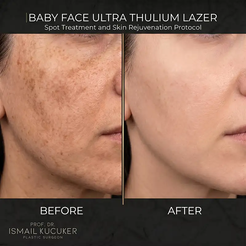 Baby Face Ultra Thulium Laser full face skin resurfacing clinical result - Prof. Dr. Ismail Kucuker Istanbul