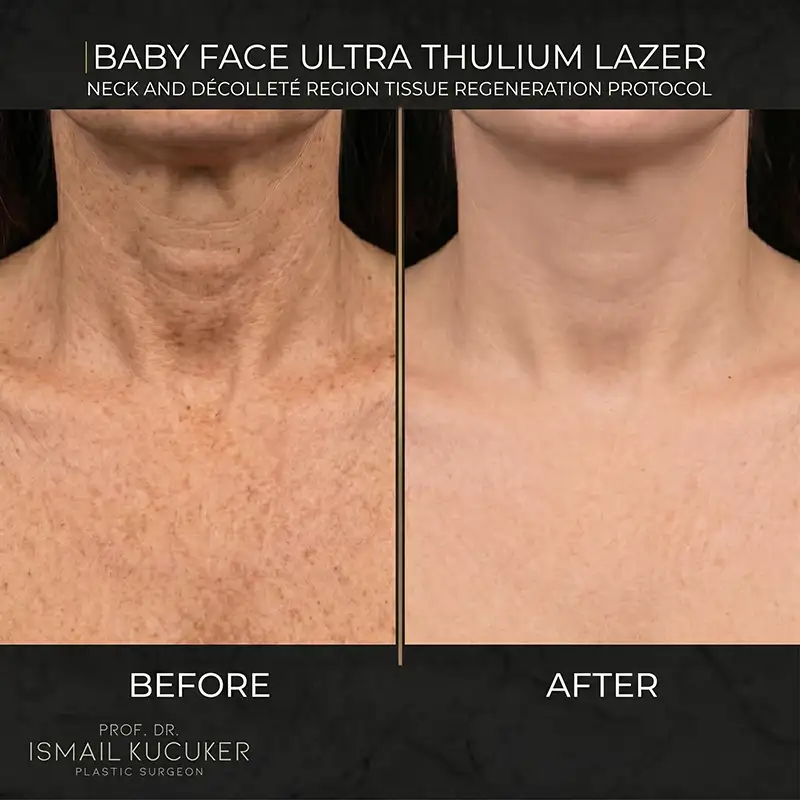 Baby Face Ultra Thulium Laser neck and décolletage rejuvenation clinical result - Istanbul Clinic