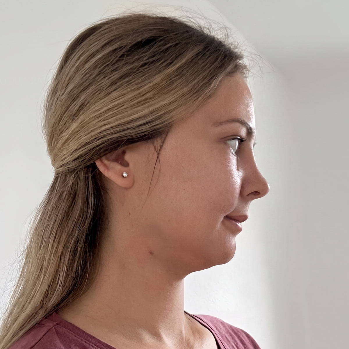 Chin Implant Surgery Mentoplasty