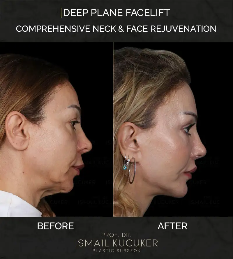 Before and after surgical facelift and deep plane facial rejuvenation results by Prof. Dr. Ismail Kucuker Istanbul, Case 1.