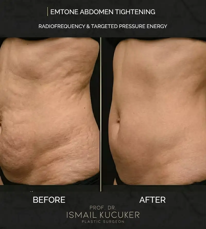 Emtone non-surgical abdominal skin tightening and contouring clinical result - Prof. Dr. Ismail Kucuker Istanbul