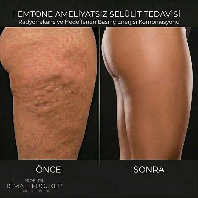 Emtone Bacak Selülit Tedavisi Öncesi ve Sonrası Bacak bölgesi selülit giderme uygulaması öncesi sonrası - Emtone cihazı sonuçları.