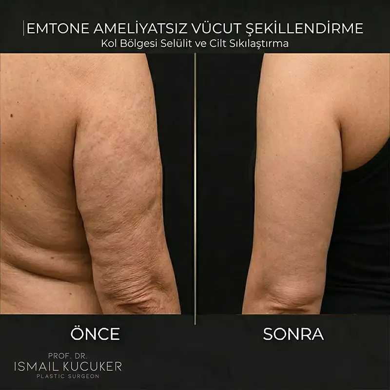 Emtone Karın Bölgesi Sıkılaştırma Sonucu 1 Emtone ameliyatsız karın ve göbek bölgesi sıkılaştırma ve selülit tedavisi öncesi sonrası karşılaştırma görseli.