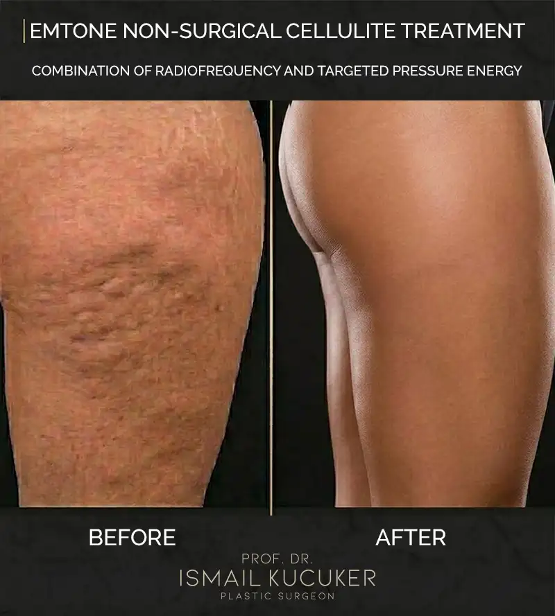 Thigh area non-surgical cellulite removal before and after results with Emtone - Prof. Dr. Ismail Kucuker Clinic