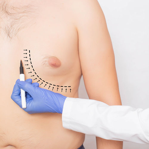 Gynecomastia Male Breast Reduction Surgery