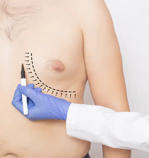 Gynecomastia Male Breast Reduction Surgery