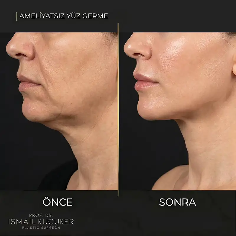 Prof. Dr. İsmail Küçüker Kliniği Hera Radyofrekans Yüz Gençleştirme Sonuçları
