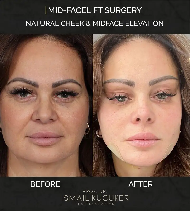 Total facial contouring and deep plane facelift procedure before and after by Prof. Dr. Ismail Kucuker Istanbul, Case 3.