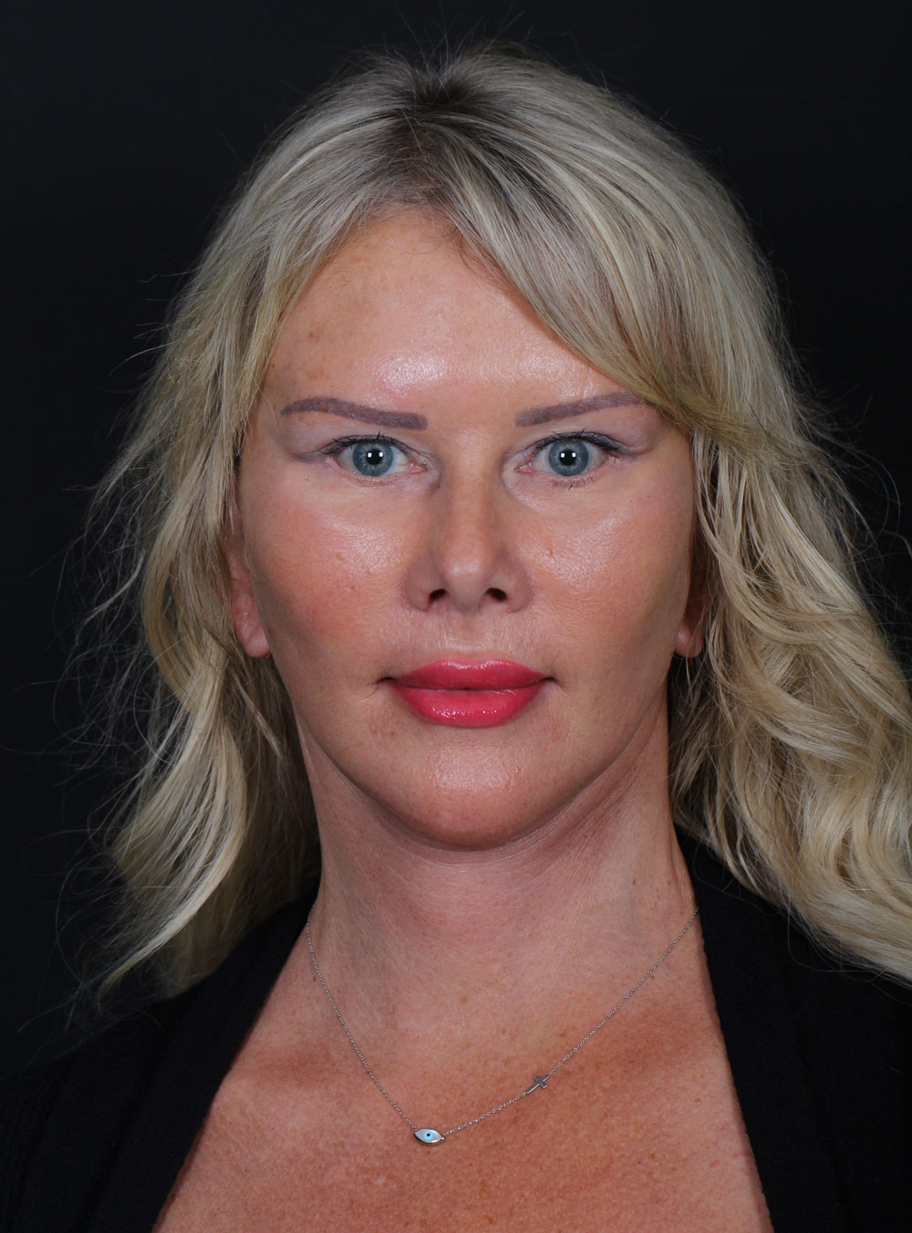 Prof. Dr. İsmail Küçüker Clinic Deep Plane Facelift Surgery Before and After Results for Surgical Jawline and Midface Lifting