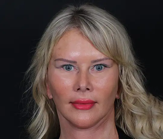 Prof. Dr. İsmail Küçüker Clinic Deep Plane Facelift Surgery Before and After Results for Surgical Jawline and Midface Lifting