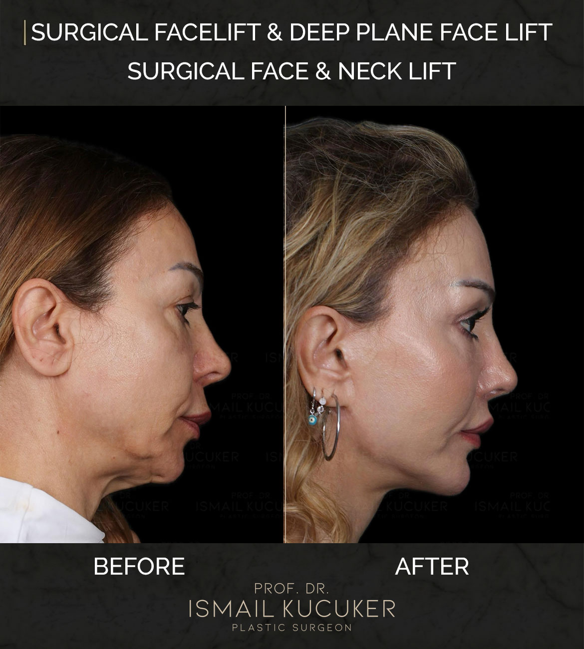 Before and after surgical facelift and deep plane facial rejuvenation results by Prof. Dr. Ismail Kucuker, Case 1.