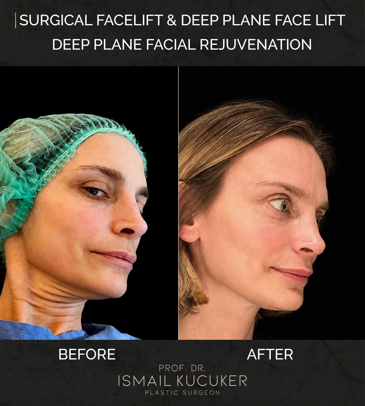 Surgical face lift and jawline redefinition before and after outcome by Prof. Dr. Ismail Kucuker, Case 2.