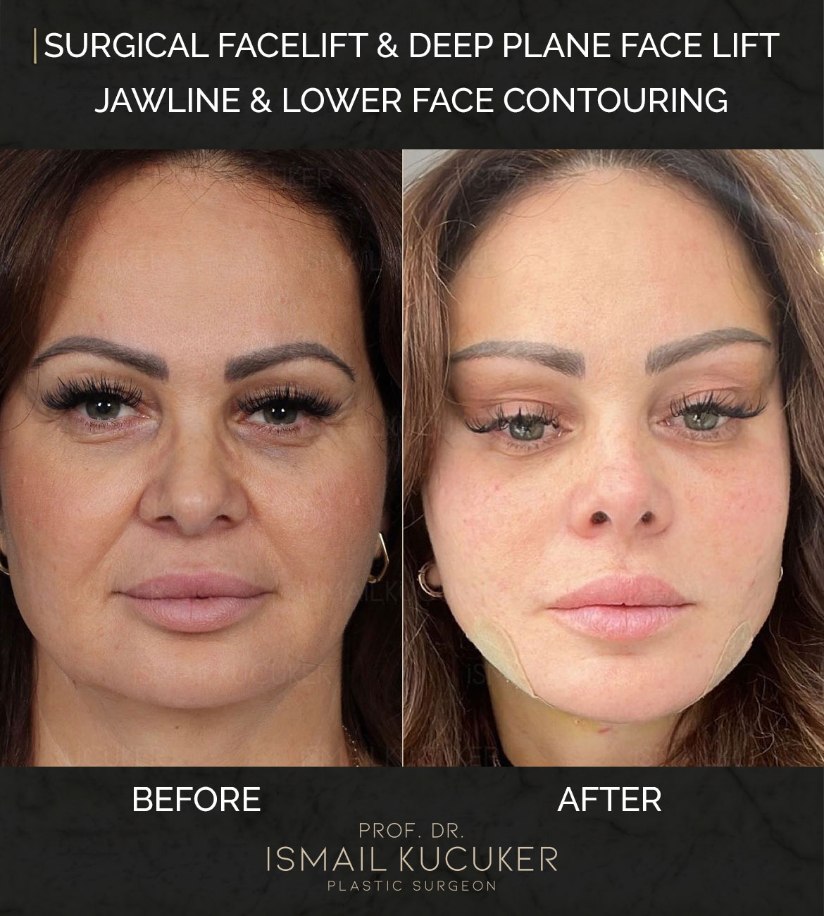 Total facial contouring and deep plane facelift procedure before and after by Prof. Dr. Ismail Kucuker, Case 3.