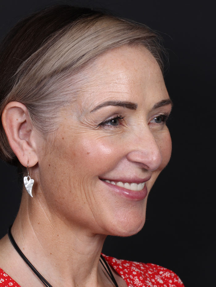 Yüz Germe Ameliyatı (Facelift)