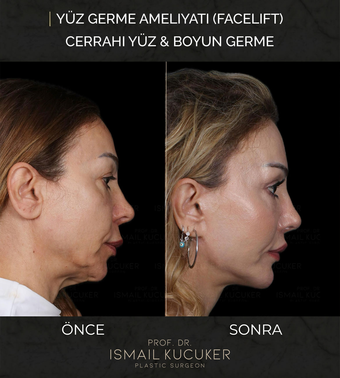 Prof. Dr. İsmail Küçüker Yüz Germe ve Derin Plan Yüz Gençleştirme Vakası 1 - Öncesi ve Sonrası