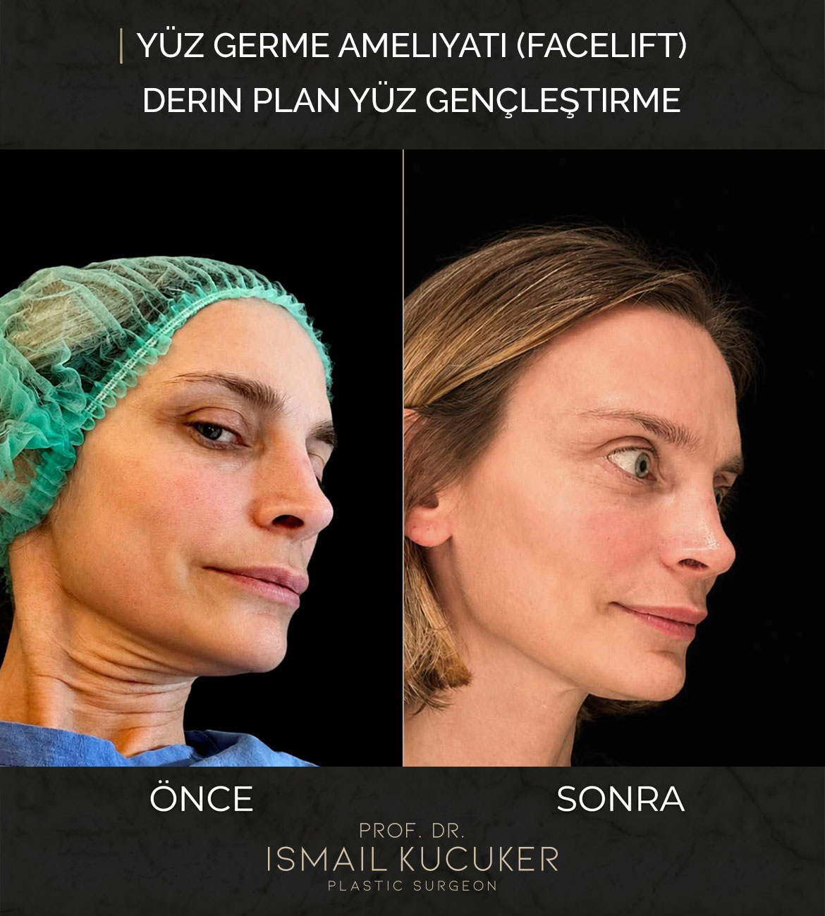 Prof. Dr. İsmail Küçüker Yüz Germe ve Çene Hattı Belirginleştirme Vakası 2 - Öncesi ve Sonrası
