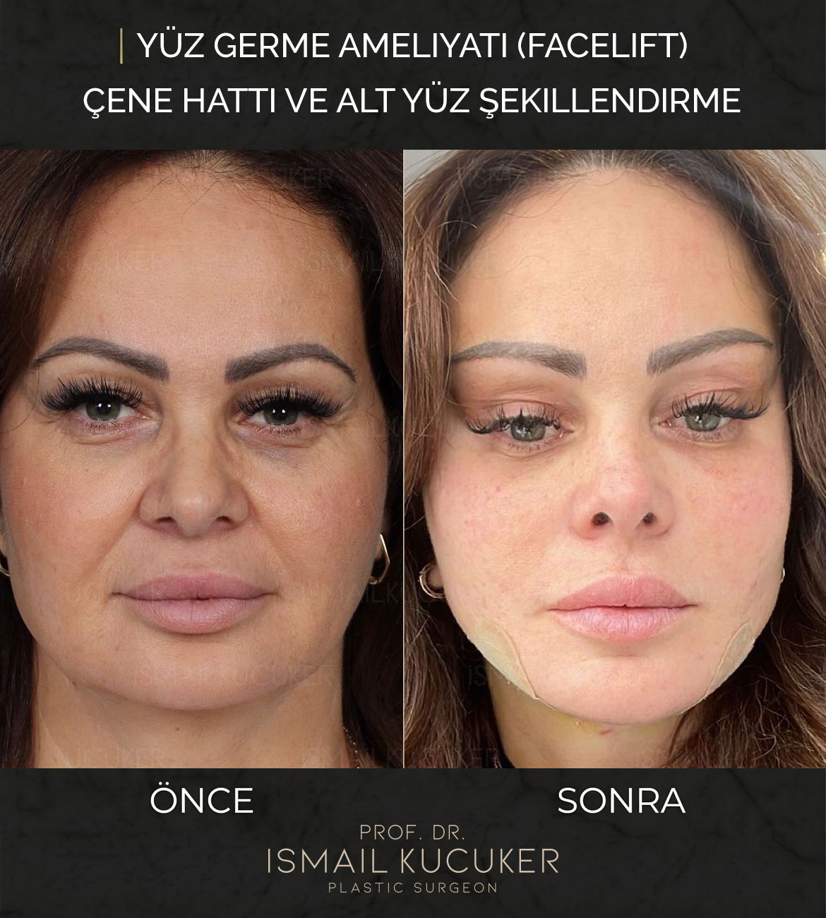 Prof. Dr. İsmail Küçüker Derin Plan Facelift ve Yüz Konturlama Vakası 3 - Öncesi ve Sonrası