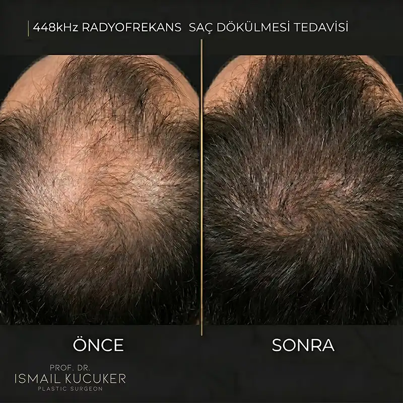 Hera Radyofrekans Teknolojisi Saç Canlandırma ve Dökülme Tedavisi Öncesi Sonrası